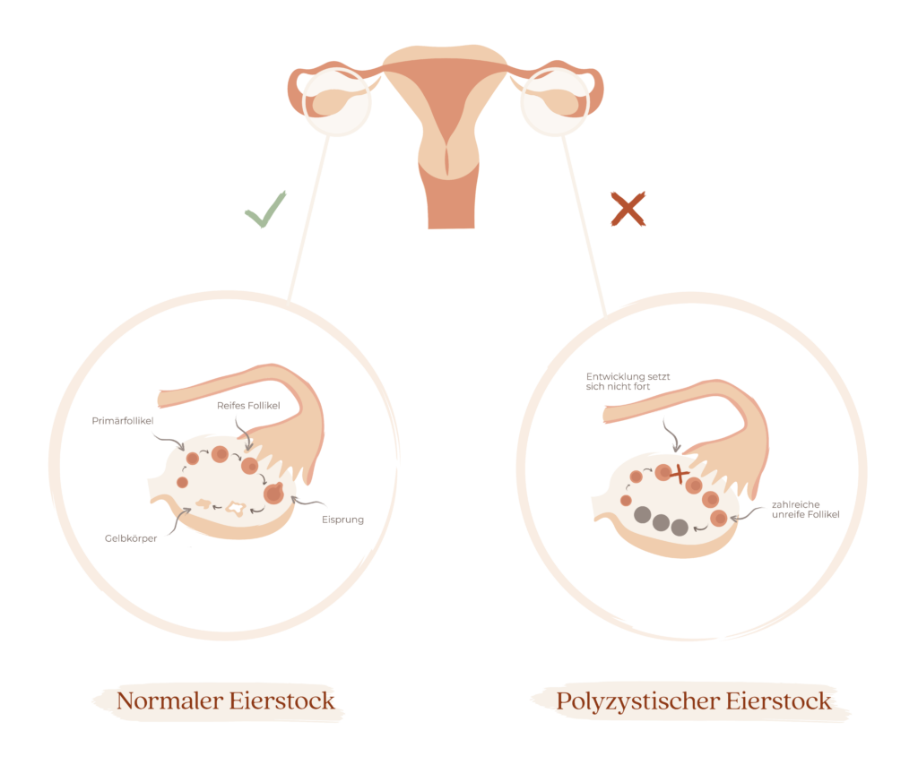 Zysten an den Eierstöcken bei PCOS vs. gesunde Eierstöcke